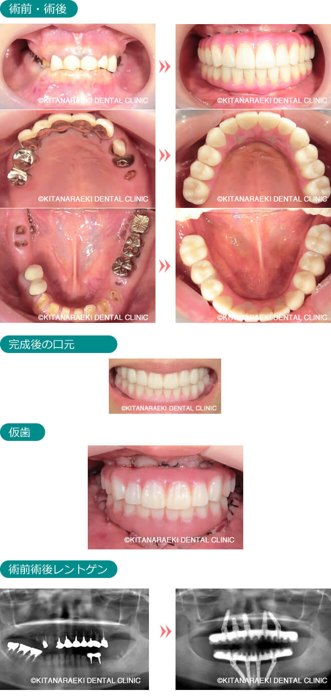 オールオンフォー（All-On-4）
